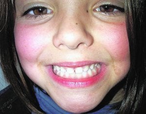 Rechinar de dientes en la infancia