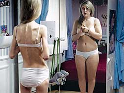 La enferma de anorexia nerviosa distorsiona su imagen corporal./